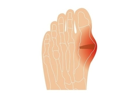 Anatomische Darstellung eines Hallux Valgus, einer Fehlstellung des großen Zehs mit roter Markierung auf der Außenseite des linken Fußes