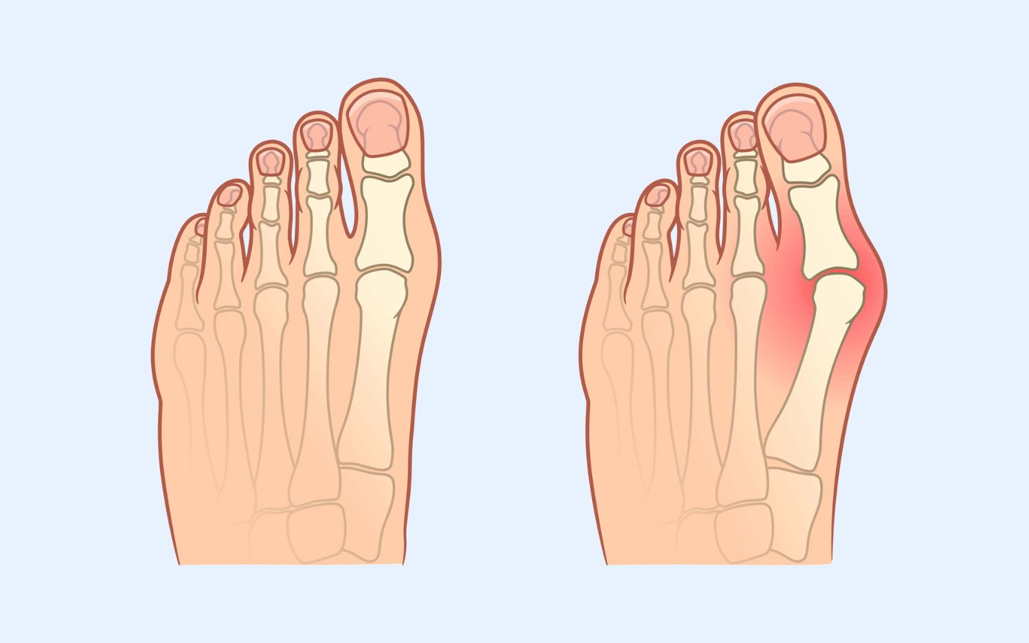 Illustration von zwei Füßen mit Knochenansicht: links ein gesunder Fuß, rechts ein Fuß mit Hallux valgus-Deformität.