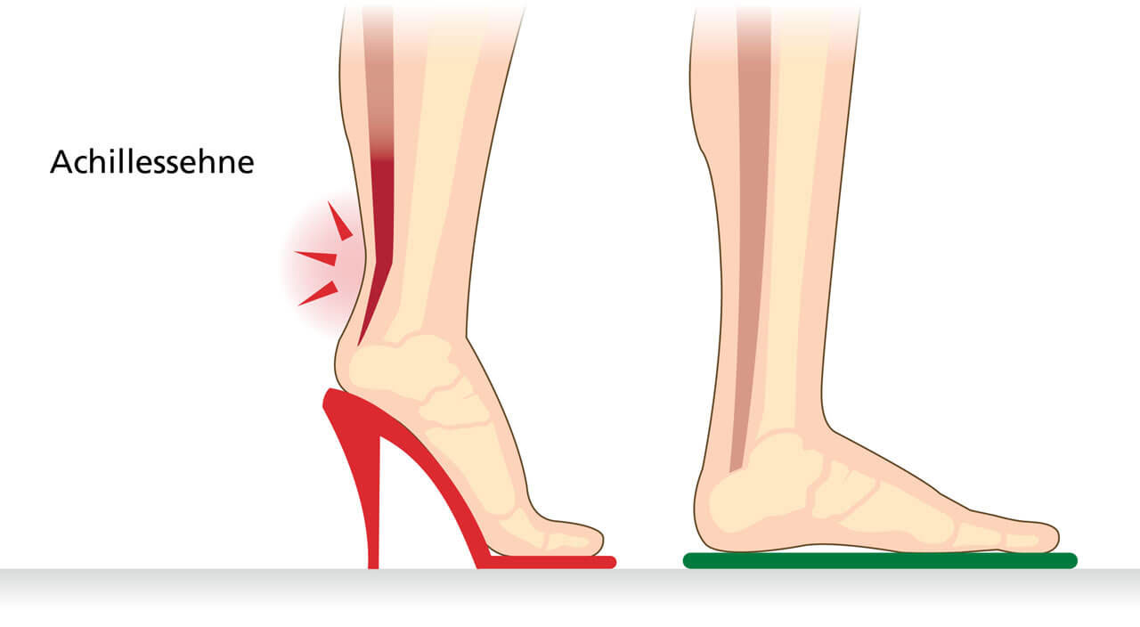 Grafische Darstellung der Achillessehne, die Belastung und Druck durch das Tragen von hohen Absätzen und flachen Schuhen zeigt.