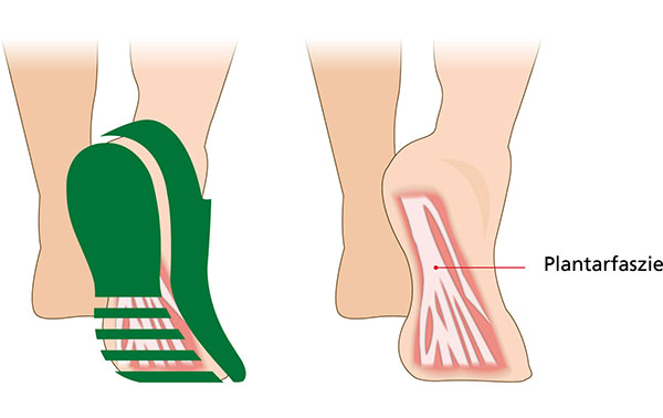 Illustration zeigt Plantarfaszie im Fuß mit Querschnitt und Seitenansicht.